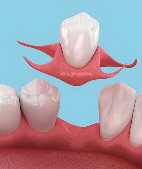 The Implant Process at Lakeshore Dental
