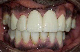 Replaced front tooth