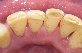 Healthy smile after tartar removal