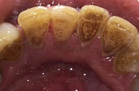 Tartar buildup inside of teeth