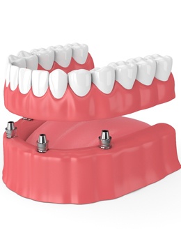 Animation of implant-retained dentures