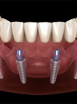 Implant-supported denture animation