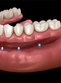 implant denture