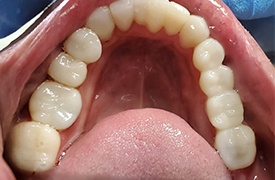 Row of teeth after treatment