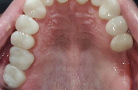 Missing teeth before treatment