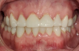 Closeup of smile after treatment