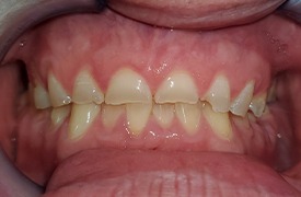 Closeup of smile before treatment