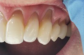 Closeup of receding gums