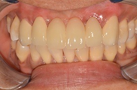 Closeup smile after treatment