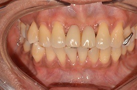 Closeup smile before treatment