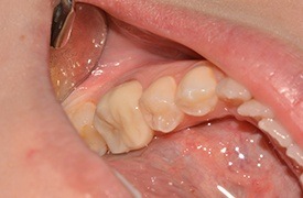 Closeup of flawless smile after treatment