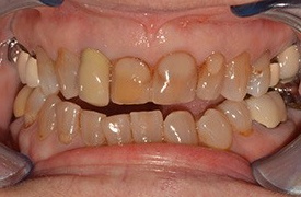 Closeup of decayed and discolored teeth