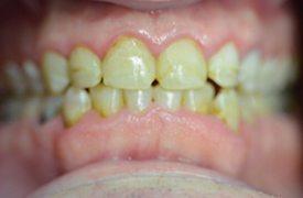 Yellowed teeth