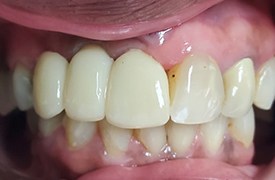 Closeup smile after treatment