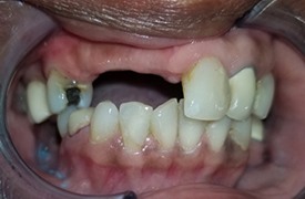 Closeup smile before treatment