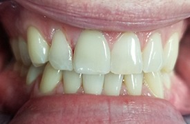 Repaired tooth after treatment