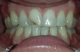 Broken tooth before treatment