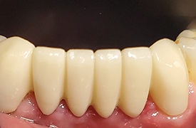 Teeth after treatment
