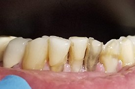Crooked teeth before treatment