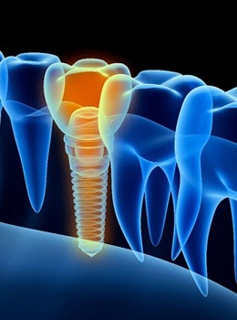 digital image of dental implant