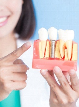 Dental Implant Model