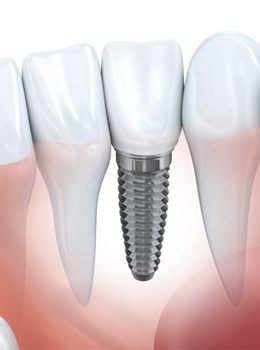 single dental implant