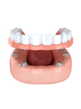 Animated implant-retained dentures
