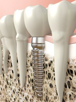 Animation of implant supported dental crown