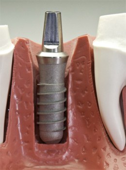 dental implant post