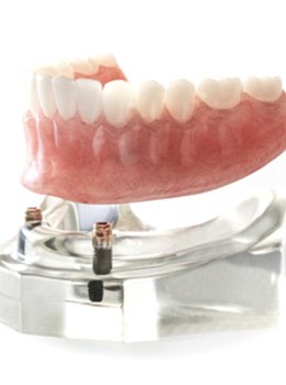 implant-retained dentures