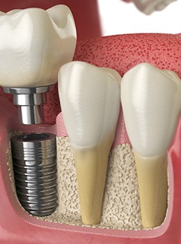 Animation of implant supported crown placement