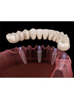 All-on-4 dental implants animation