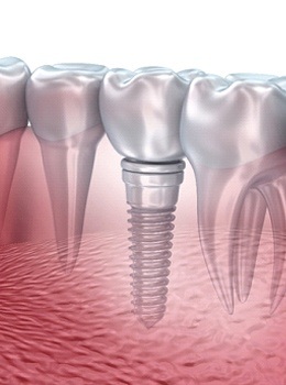 Dental implant in mouth