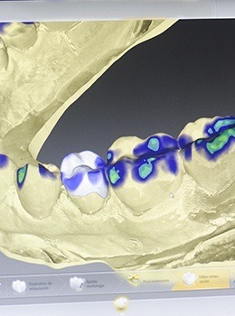 iTero dental scans