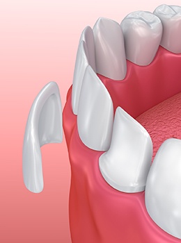 Animation of porcelain veneer placement